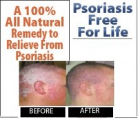   Treatment of Psoriasis of the Scalp